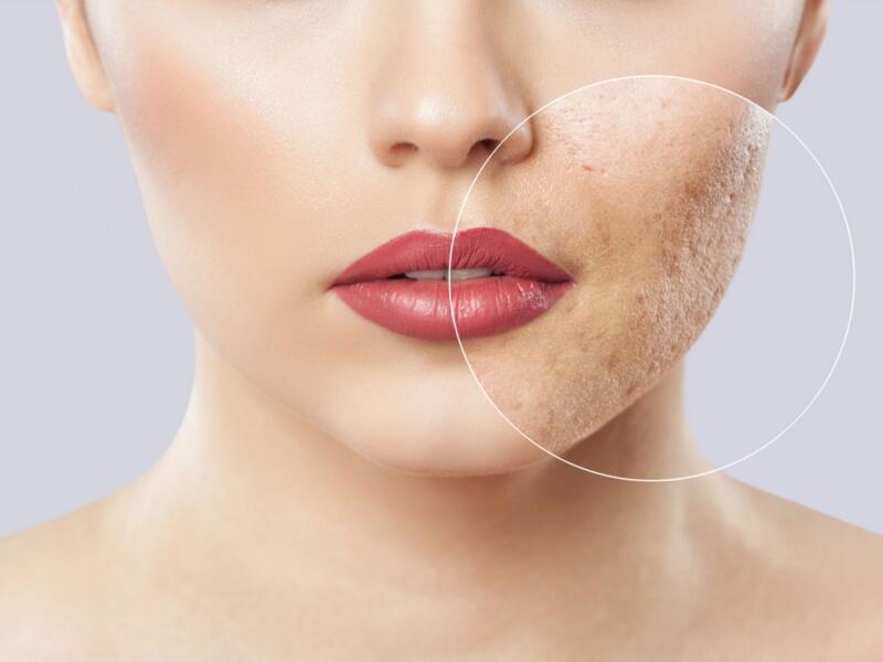 Acne scar removal with laser in Javea