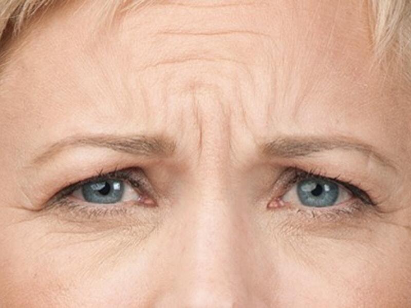 Brow Lift with Botox