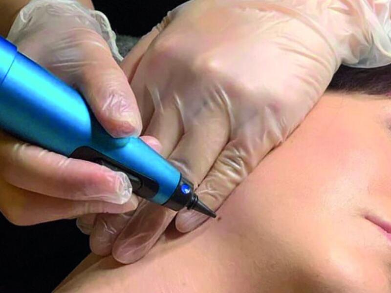 Cryopen treatment in Javea