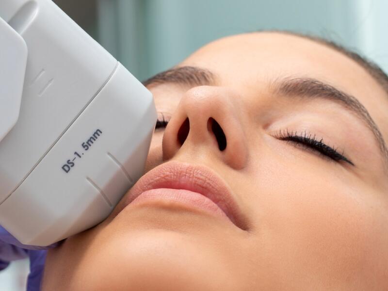 Facelift with HIFU in Javea