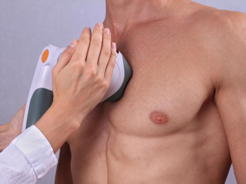 Laser Hair Removal for Men in Javea