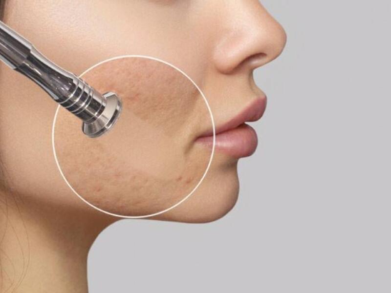 Microdermabrasion Treatment in Javea