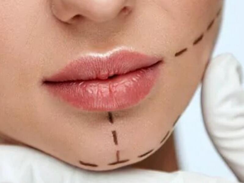The chin with Fillers in Javea