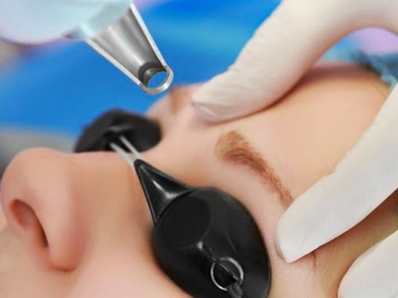 YAG Laser Skin Treatment in Javea