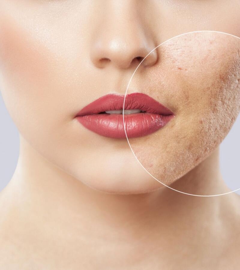 Acne Scar Removal with Laser Treatment in Javea – Effective Solutions