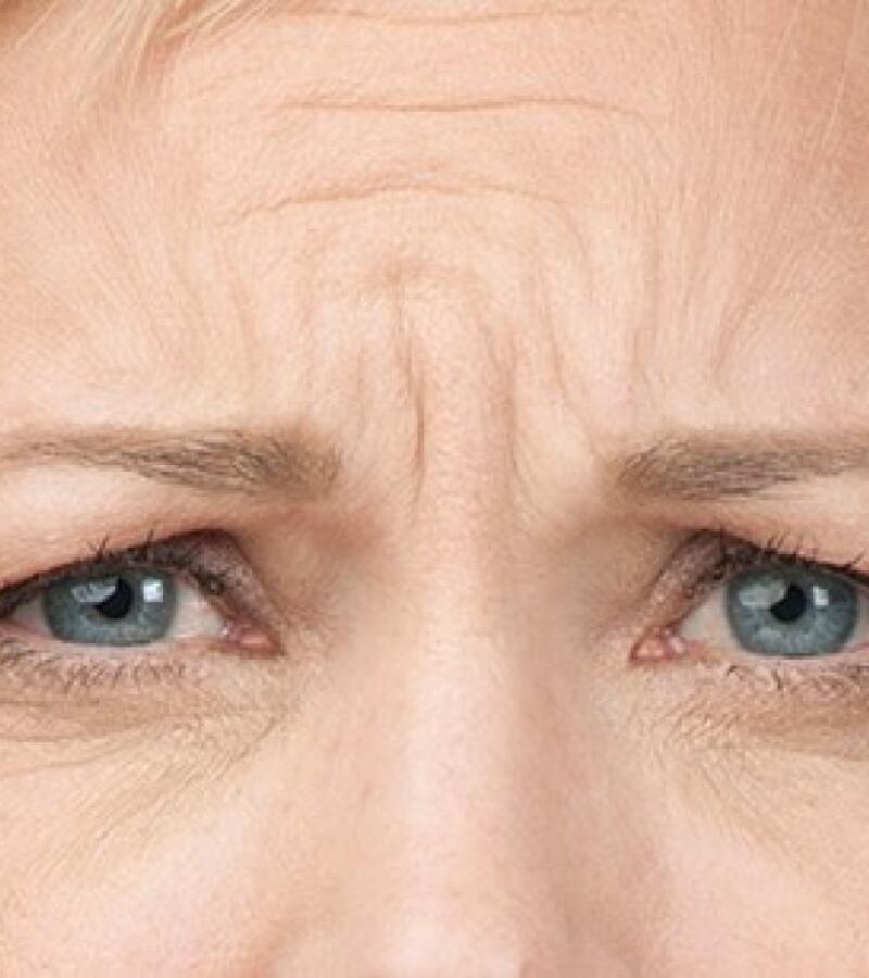 Brow Lift with Botox in Javea