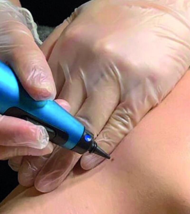 Cryopen treatment in Javea