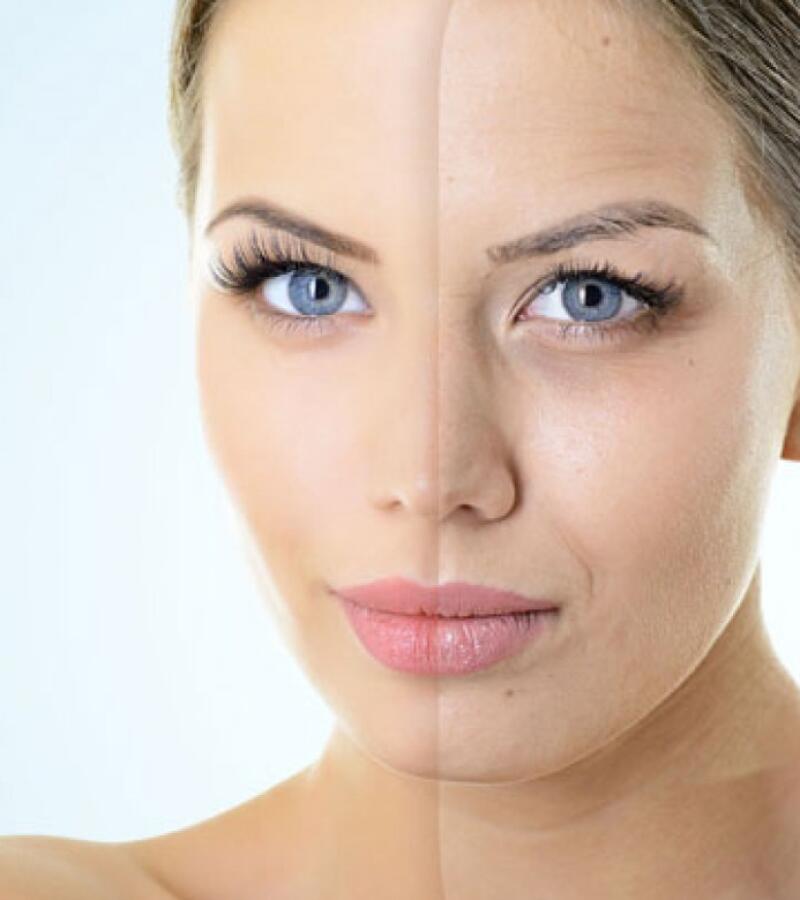 Mesotherapy - Skin quality & Hair Regrowth, Alopecia (hair loss)