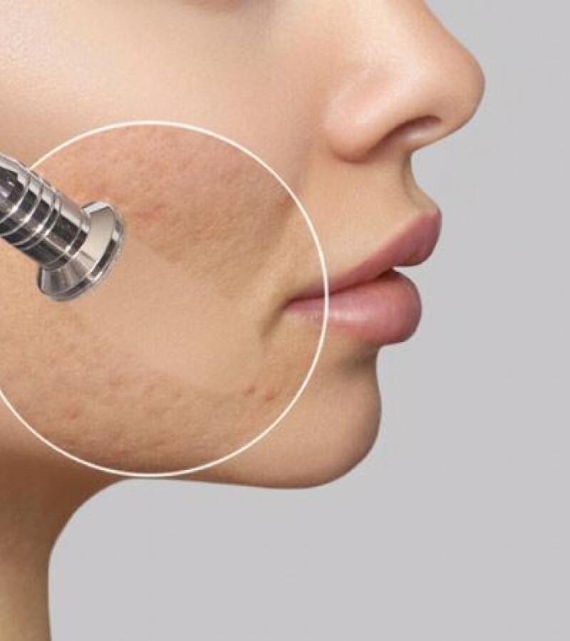 Microdermabrasion Treatment in Javea – Exfoliate and Revitalize Your Skin