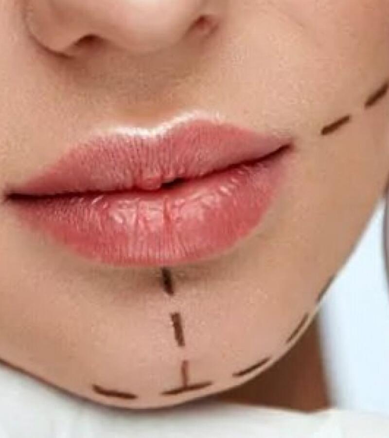 The chin with Fillers in Javea