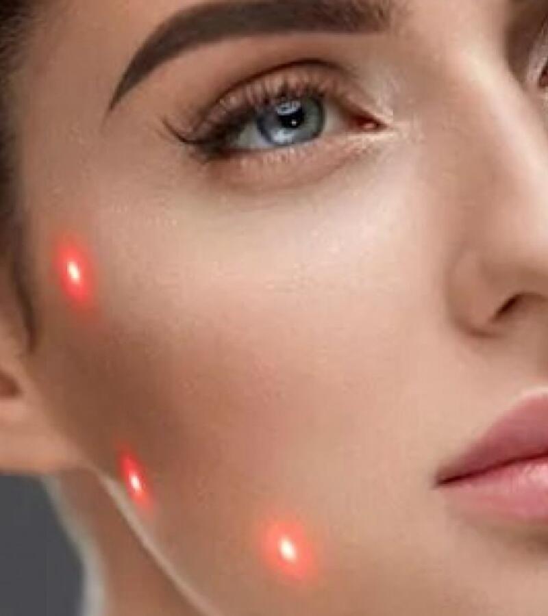 The facial Oval with filler, in Javea
