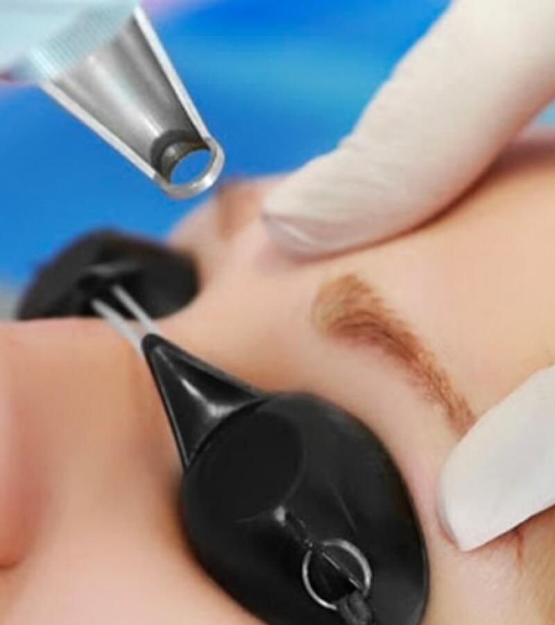 YAG Laser Skin Treatment in Javea – Effective Solution for Skin Pigmentation